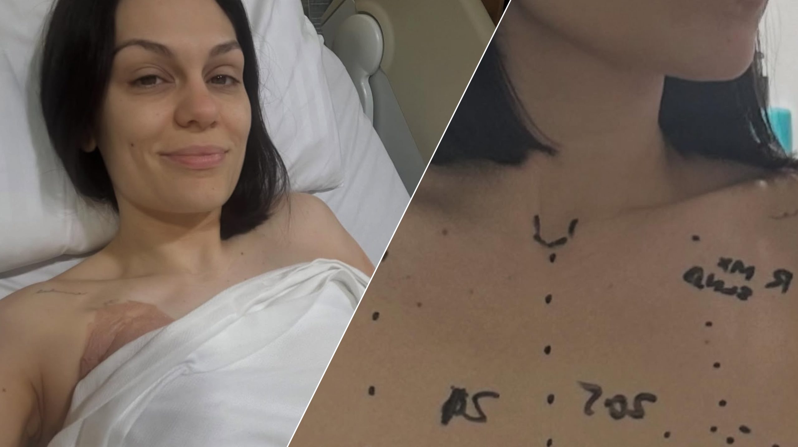 Jessie J ndan rrëfimin emocional pas operacionit të kancerit të gjirit