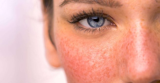 Pse rosacea përkeqësohet me kalimin e moshës?