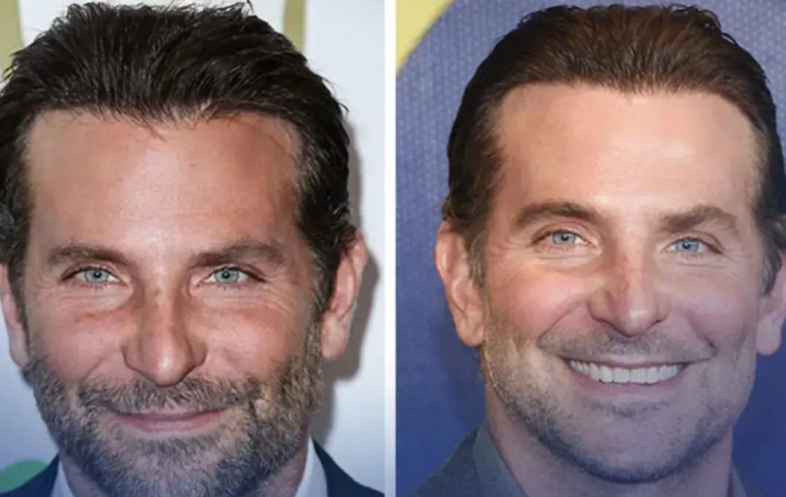 Bradley Cooper reagon për herë të parë ndaj thashethemeve për ndërhyrje plastike