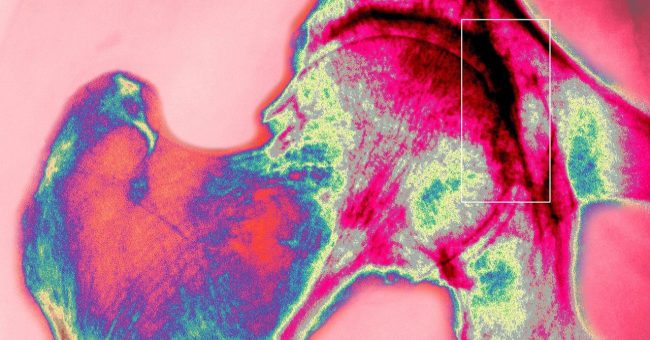 Inteligjenca artificiale po krijon implante më të forta për kockat dhe ijet
